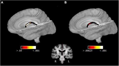 Six Months of Piano Training in Healthy Elderly Stabilizes White Matter Microstructure in the Fornix, Compared to an Active Control Group